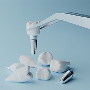 3D-gerenderte Zahnimplantate