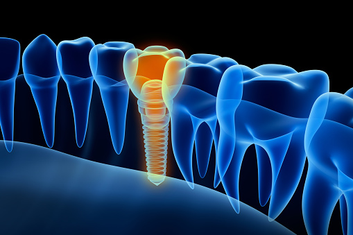 implant.jpg